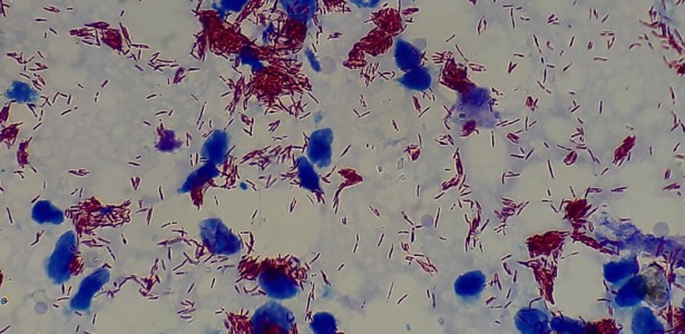 Exame de sangue associado a inteligência artificial abre caminho para diagnóstico precoce da hanseníase